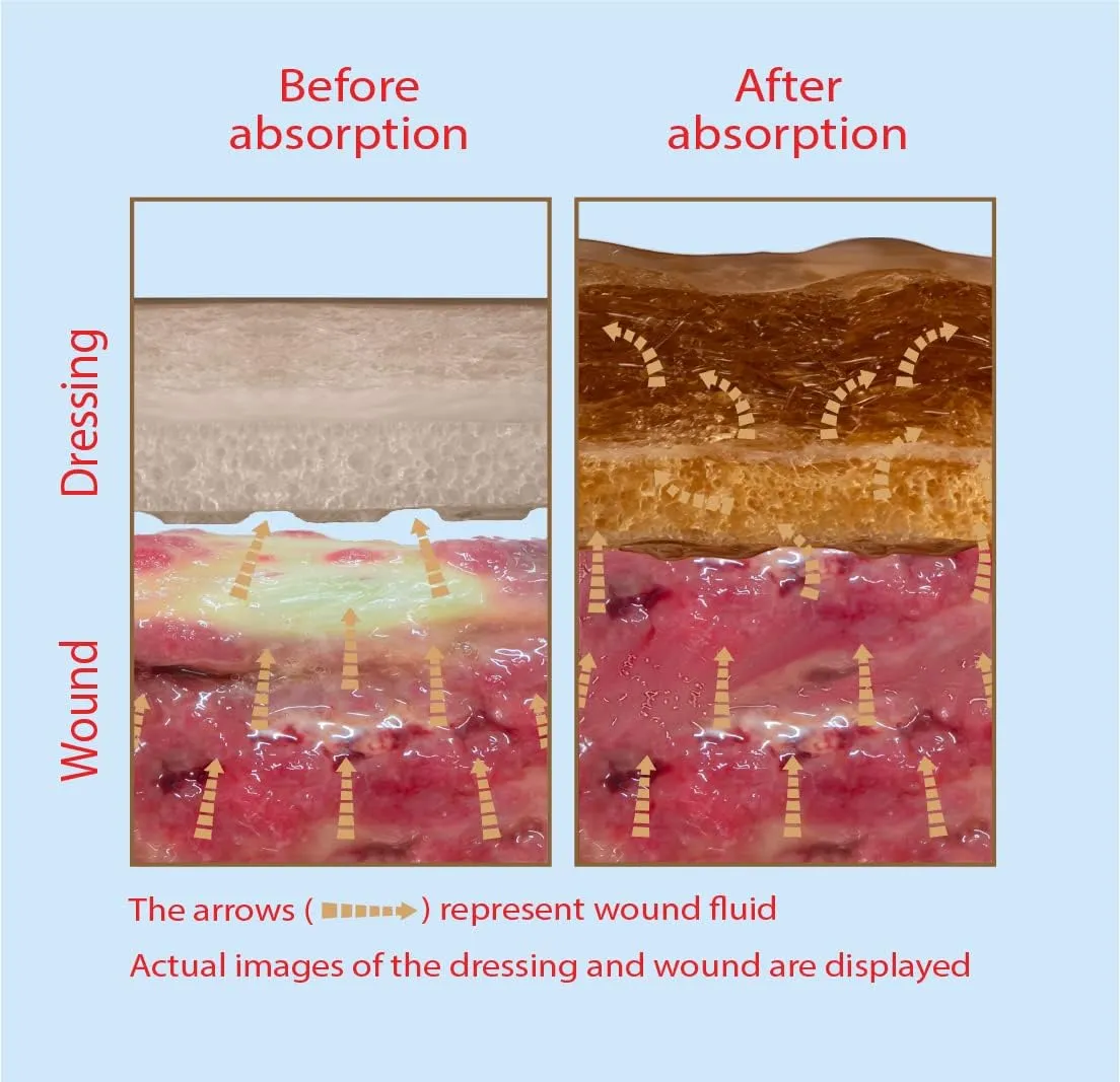 Areza Medical - Silicone Foam with Super-Absorbent Layer - Wound Dressing - Waterproof - with Silicone Adhesive Border - Sterile - 6" x 6" - 5 PCS per Box - FSA/HSA Approved